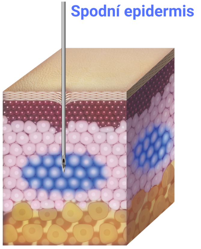 TURTLEPIN Injekční aplikátor  5 jehel / 2,0 mm / 32 G -20 ks