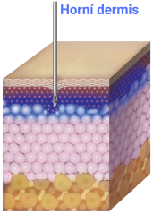 TURTLEPIN Injekční aplikátor  19 jehel / 1,0 mm / 32 G - 20 ks