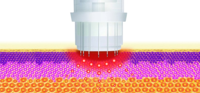 Deep shoot AA sérum - proti stárnutí - hloubka vpichu 0,5 mm - 5 x 3 ml